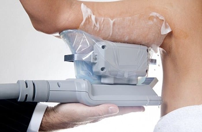 fat freezing arms Barry
