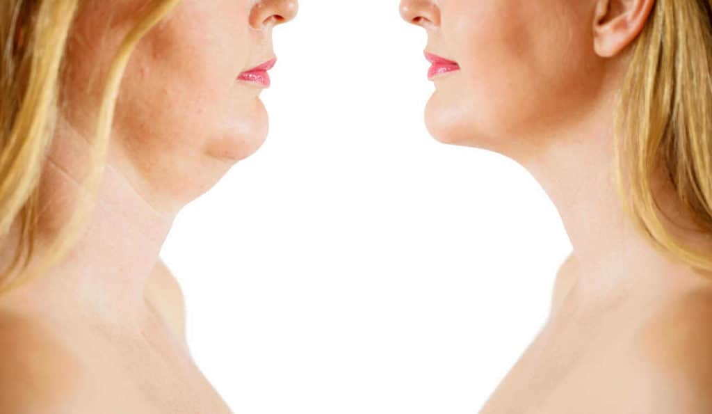 Double Chin treatment Barry before and after results