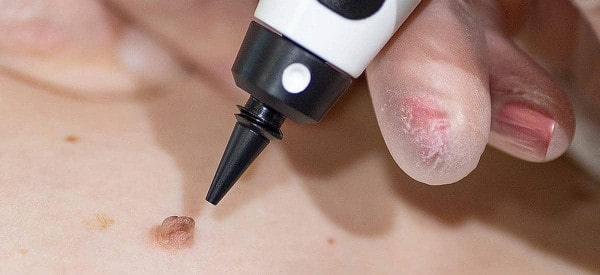 After Skin Tag Removal Barry