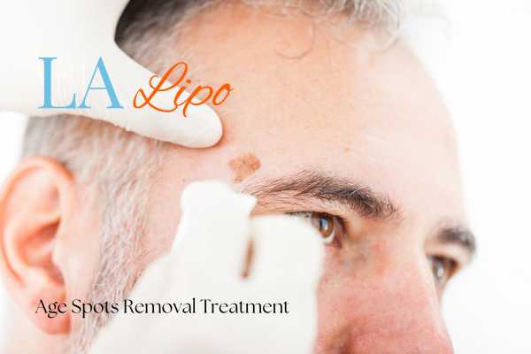 What Are the Most Effective Treatments for Age Spots Barry?