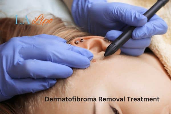 Dermatofibroma Removal Treatment Barry