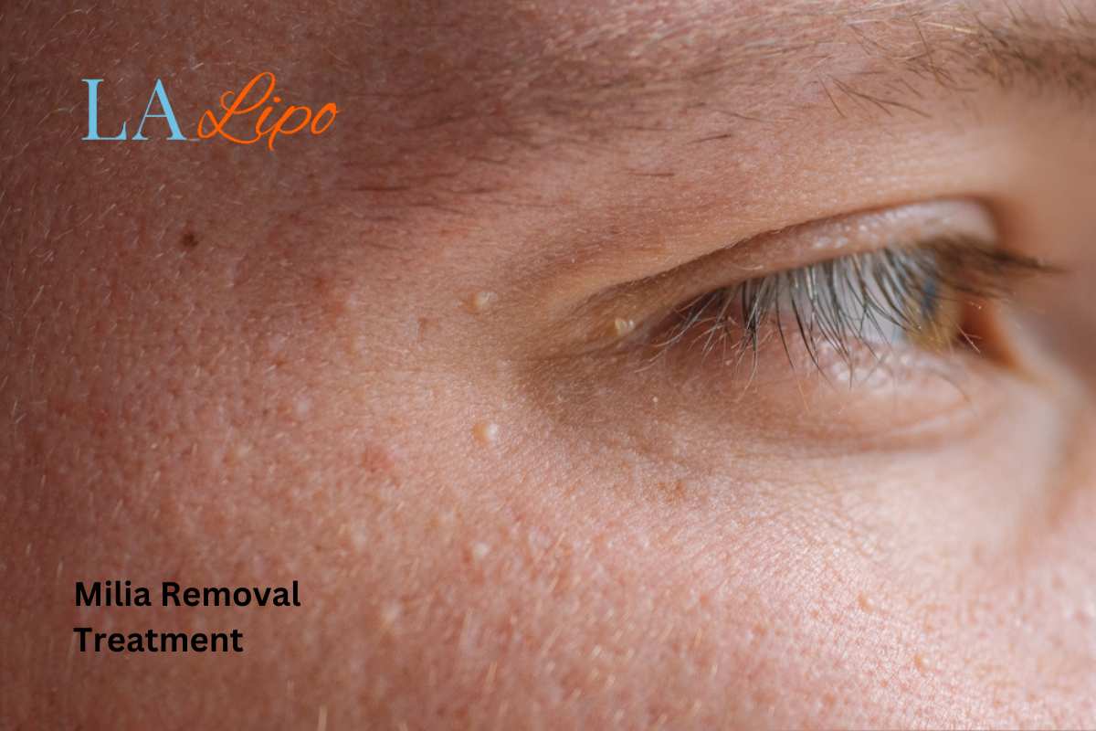 Cryopen Milia Removal: Is It the Easiest and Safest Option Barry?