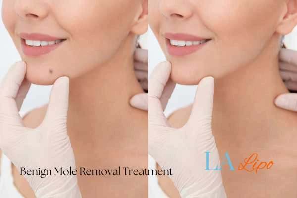 Before-and-after results following benign mole-removal treatment Barry