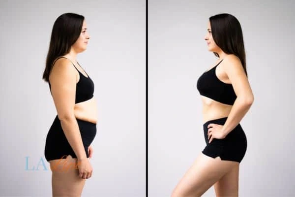 image of woman before and after results of LA-EMS Body Sculpting Barry to help treat Diastasis recti