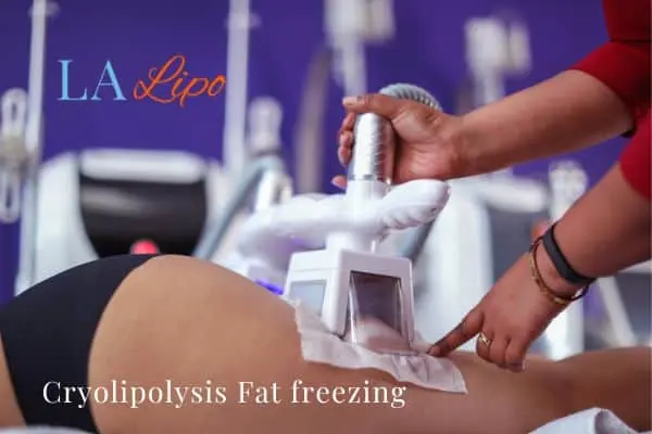 women getting fat freezing Barry