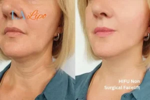 hi-fu for wrinkles Barry before and after results
