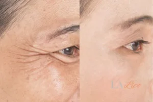 Before and after results of woman - HI-fu wrinkles reduction treatment Barry