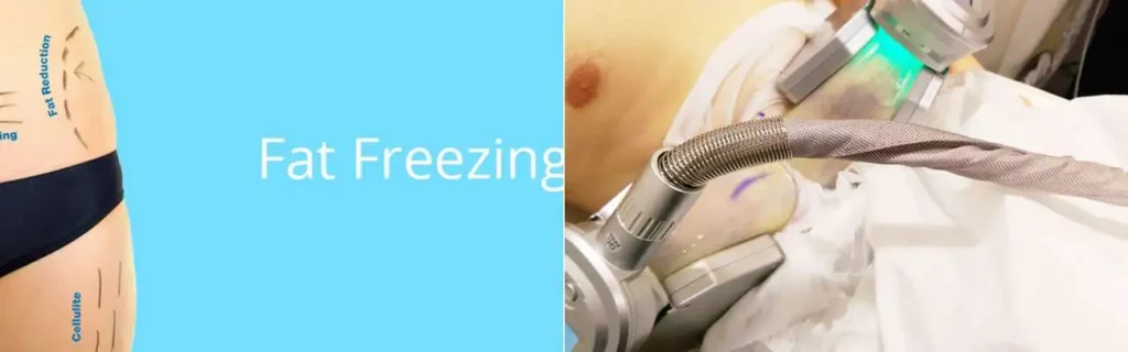 Fat freezing Barry on multiple areas of the body