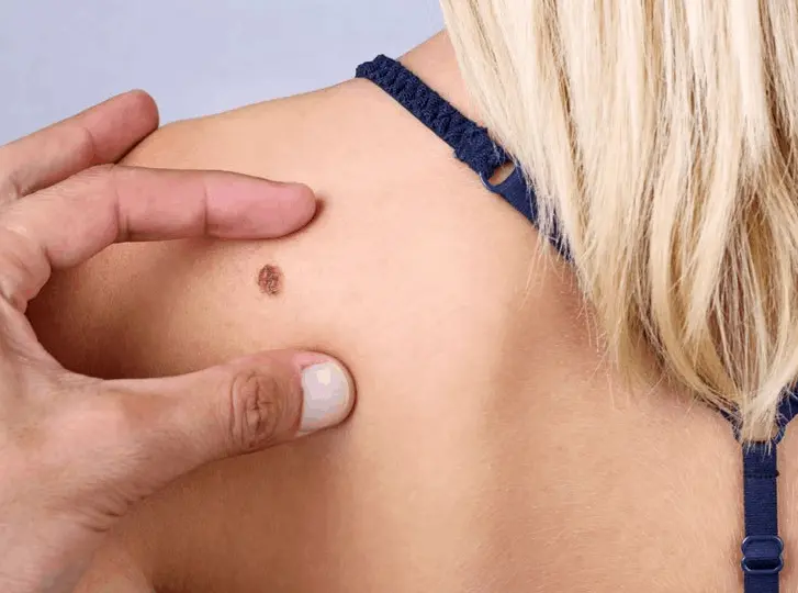 woman having mole removal Barry consultation before treatment.