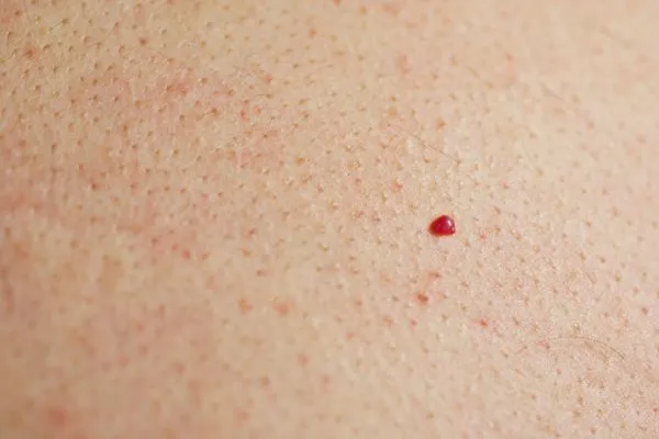 close up of a cherry angioma Barry