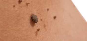 image of a skin tag Barry