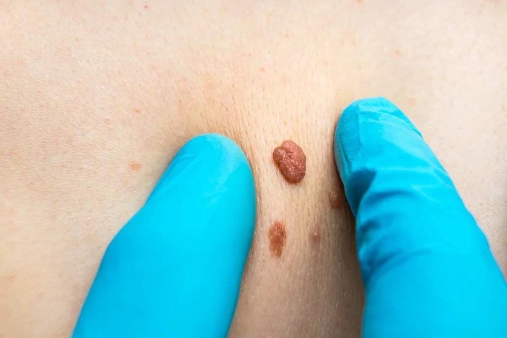 Consultant examining a skin tag Barry