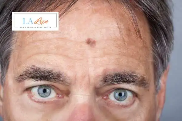 Solar Lentigo Removal Barry image of man with mark on his forehead