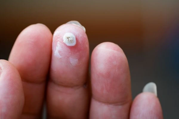 wart on person finger - cryotherapy to treat from LA LIPO Barry