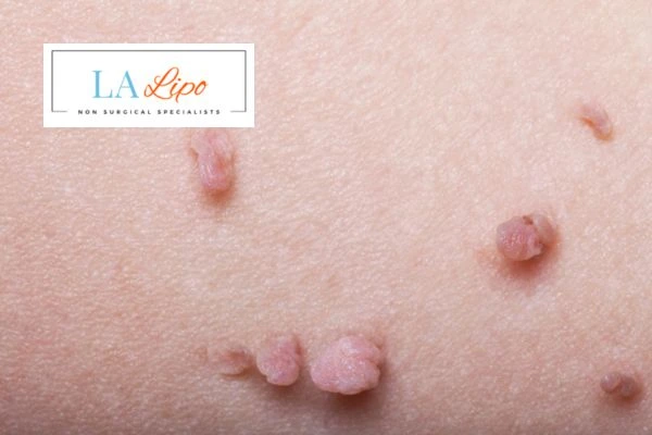 Does cryopen skin tag removal Barry hurt? Find out now call our team today!