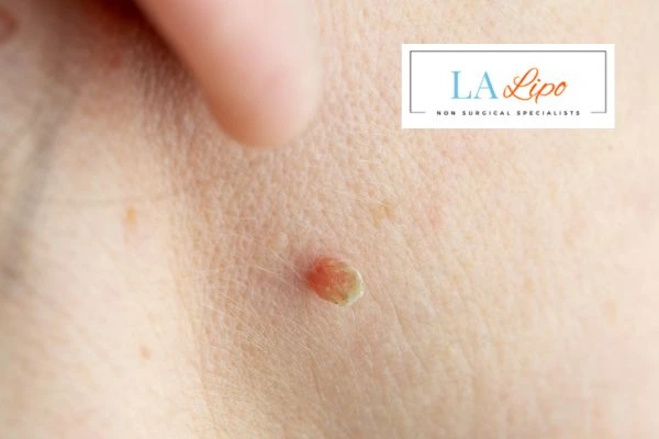 Book skin tag removal Barry today speak to our team now!