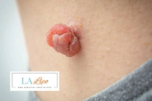 Interested in skin tag removal Barry? Concerned about the pain? Find out more today!
