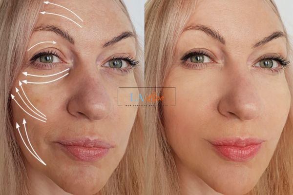 Morpheus 8 results Barry face lift.