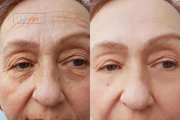 The powerful benefits of Morpheus8 Treatment Barry - Call Our team today!