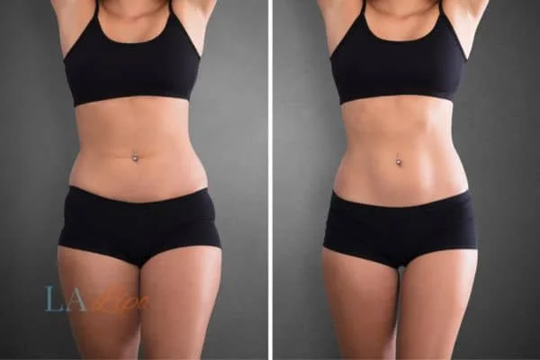 before and after results of non-surgical treatment to help a woman's body image and mental health Barry