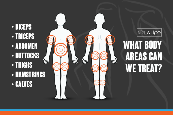 Diagram to show areas you can have LA-EMS Body Sculpting Treatment Barry