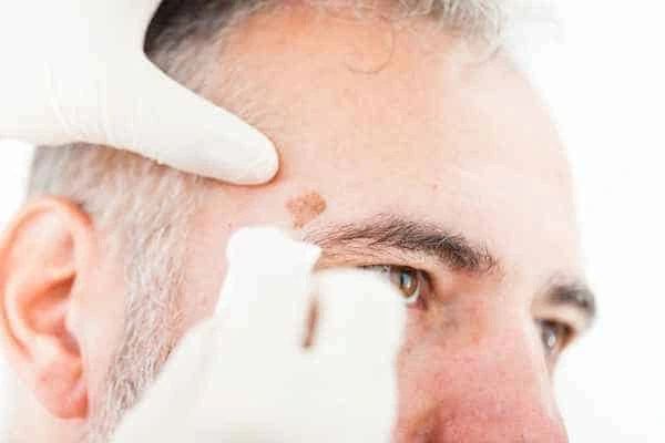 Age spots and elderly people Barry what is the link?