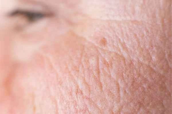 close up picture of a woman's face showing an age spot Barry