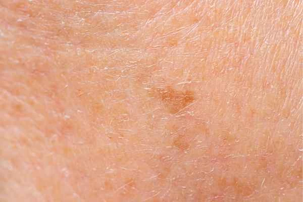 close up picture of age spots Barry