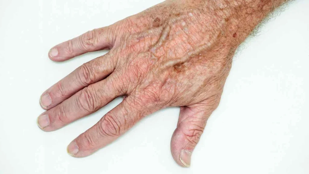 Male hand showing age spot Barry