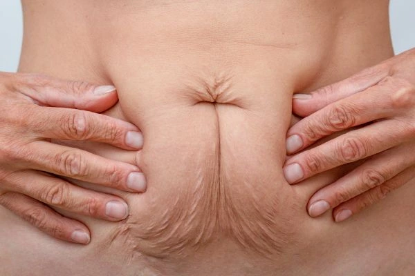 Should I Combine Diastasis Recti Treatment with Body Contouring for Better Results Barry?