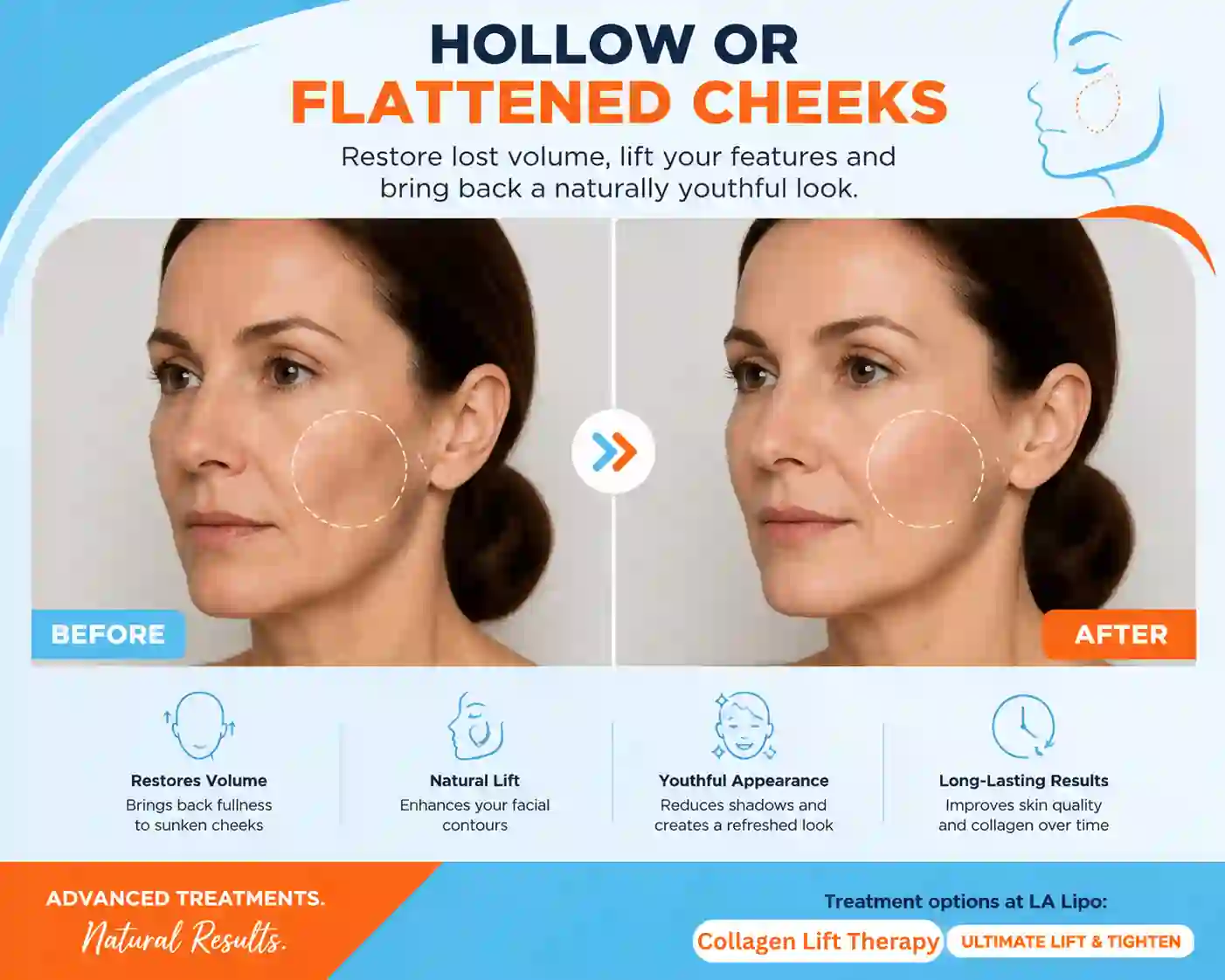 Sign #4: Hollow or Flattened Cheeks Barry
