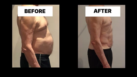 What Symptoms Can Diastasis Recti Cause in Men? Weak Core, Back Pain and Poor Posture Barry